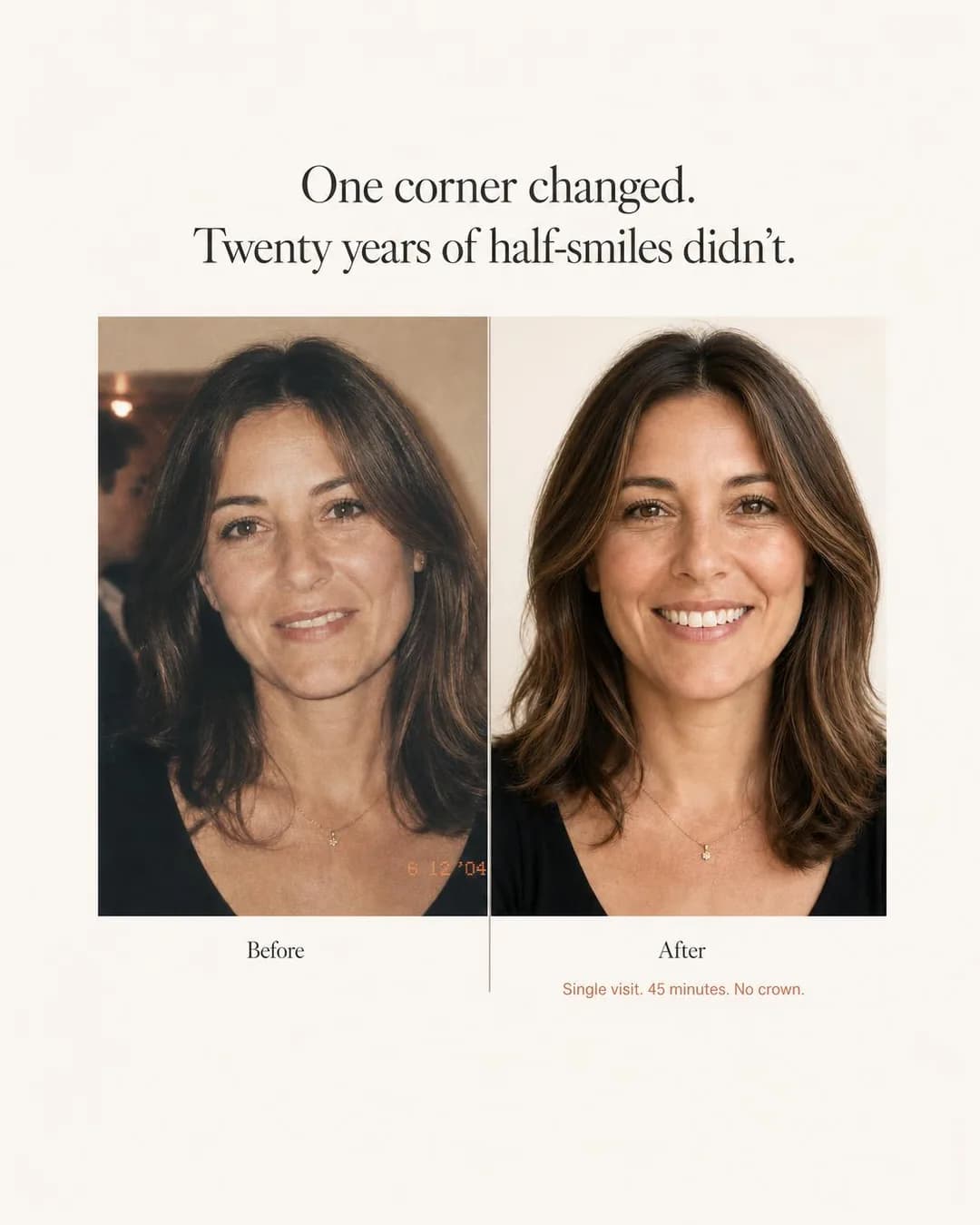 Before/after split, portrait 4:5. Contrasting the decades-long habit of hiding the tooth with a single 45-minute fix builds trust through sheer time-elapsed proof.
